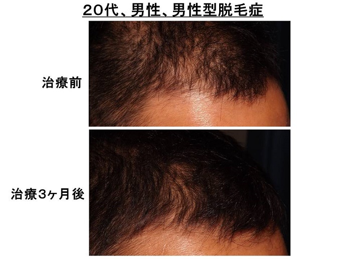 円形脱毛症　名医""